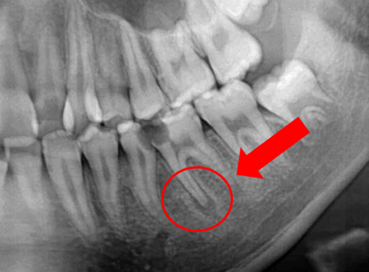 奥歯の症例